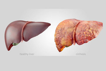 phases of non alcoholic fatty liver disease