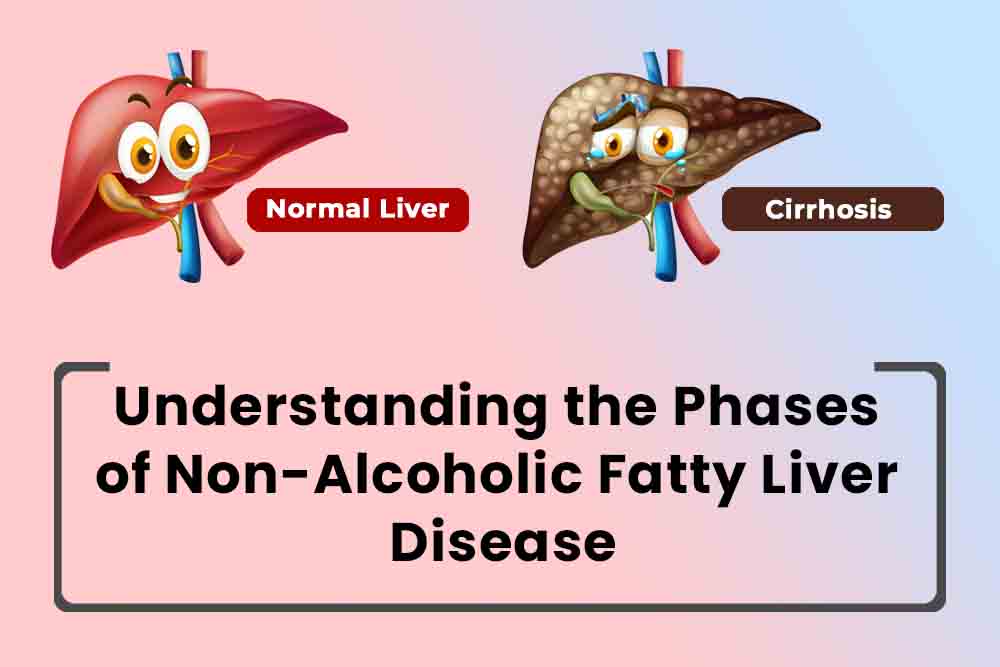 phases of non alcoholic fatty liver disease