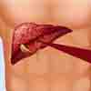 liver disease