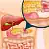 pancreatic disorder