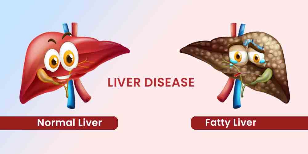liver disease